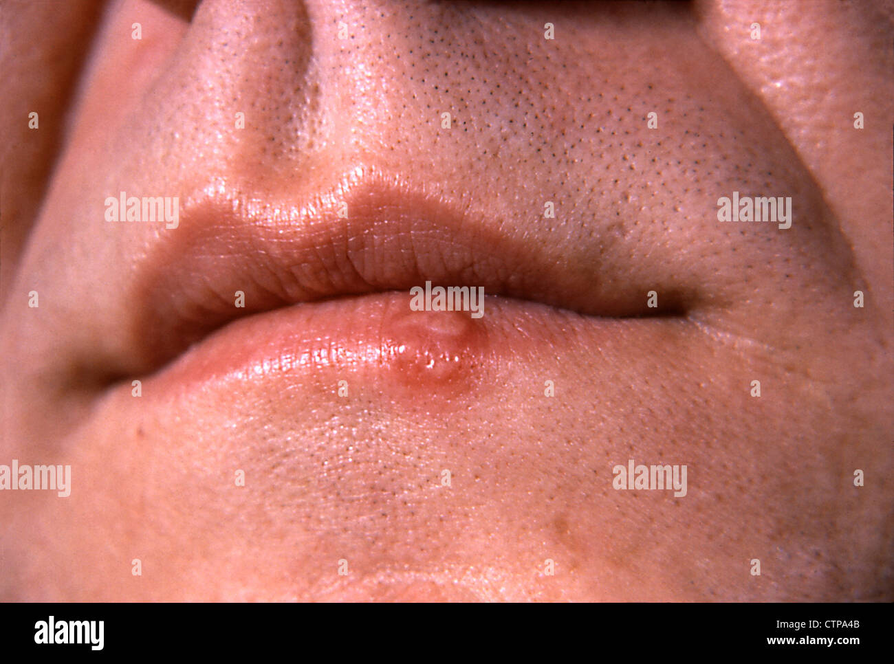 Cold sore or fever blister on the lip caused by Herpes infection Stock Photo