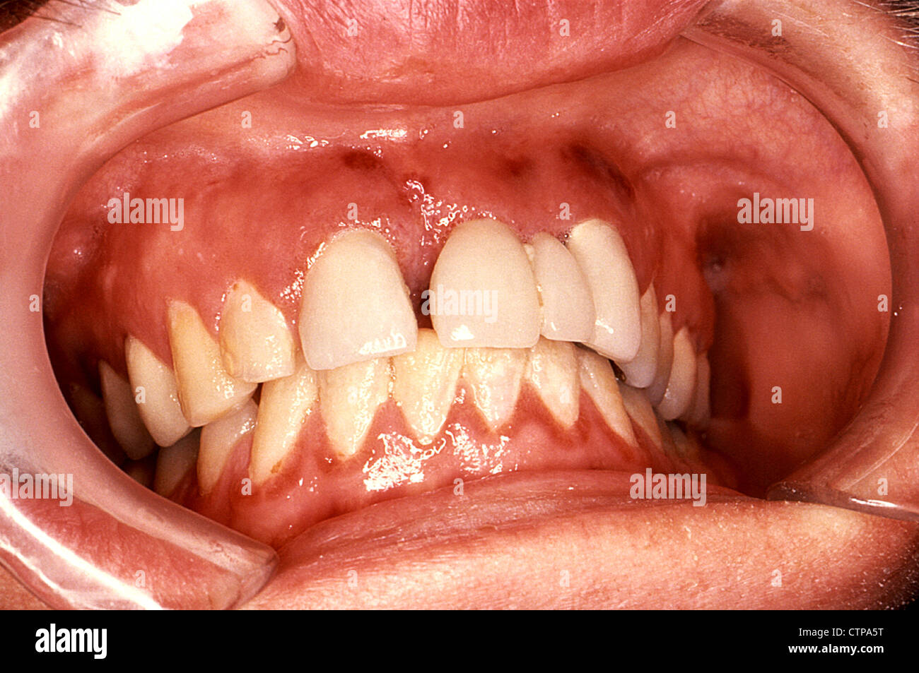 Labial and gingival Kaposi’s sarcoma in an AIDS  patient. Stock Photo