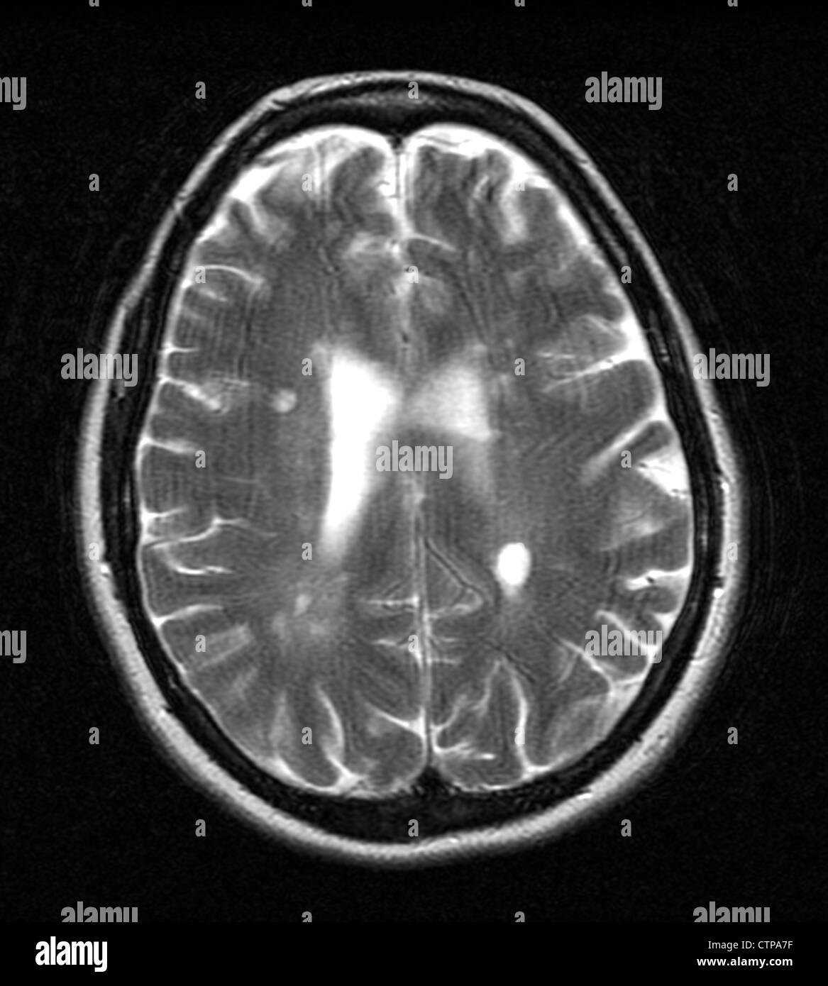MRI showing multiple sclerosis in a 42 year old woman Stock Photo