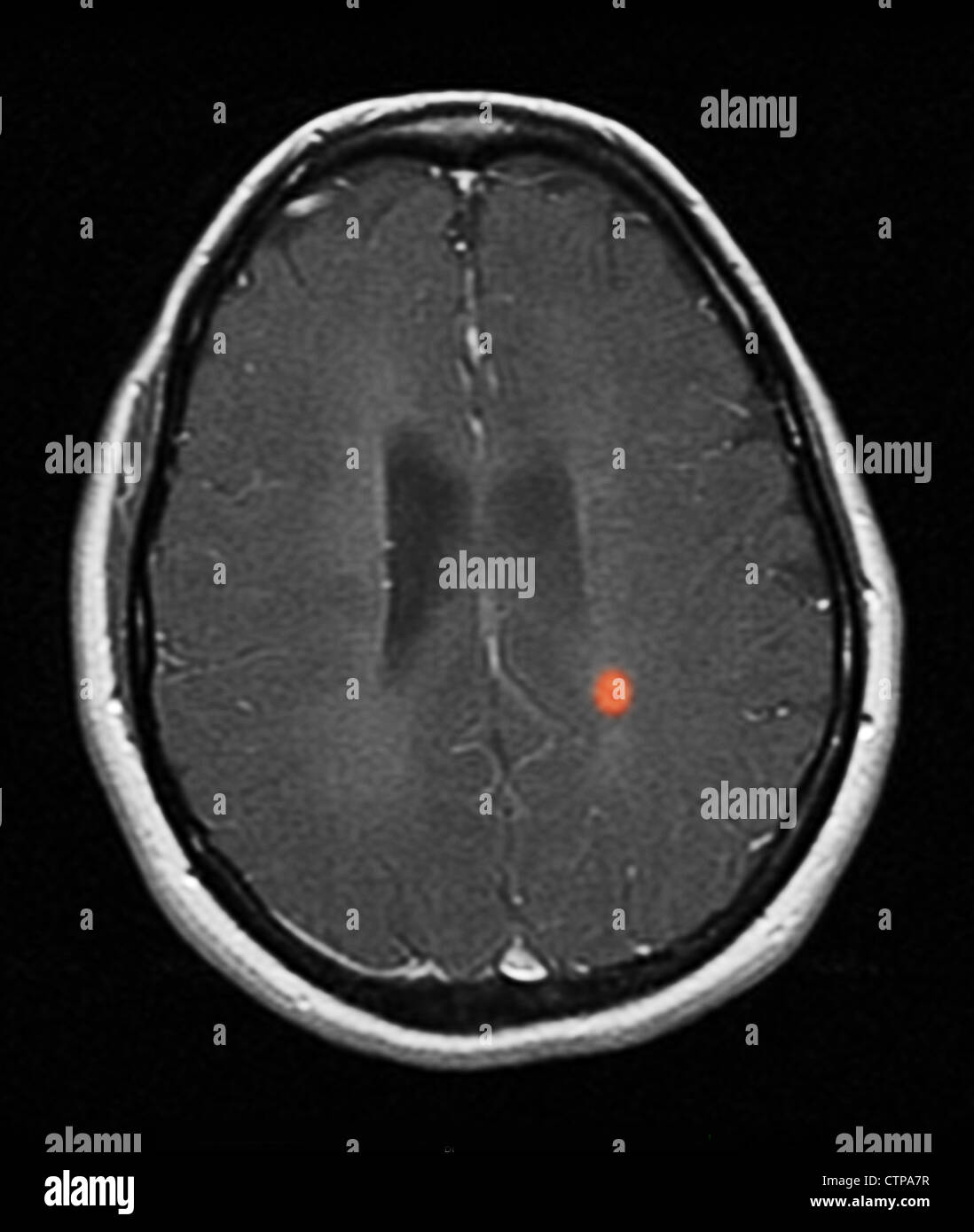 MRI showing multiple sclerosis in a 42 year old woman Stock Photo