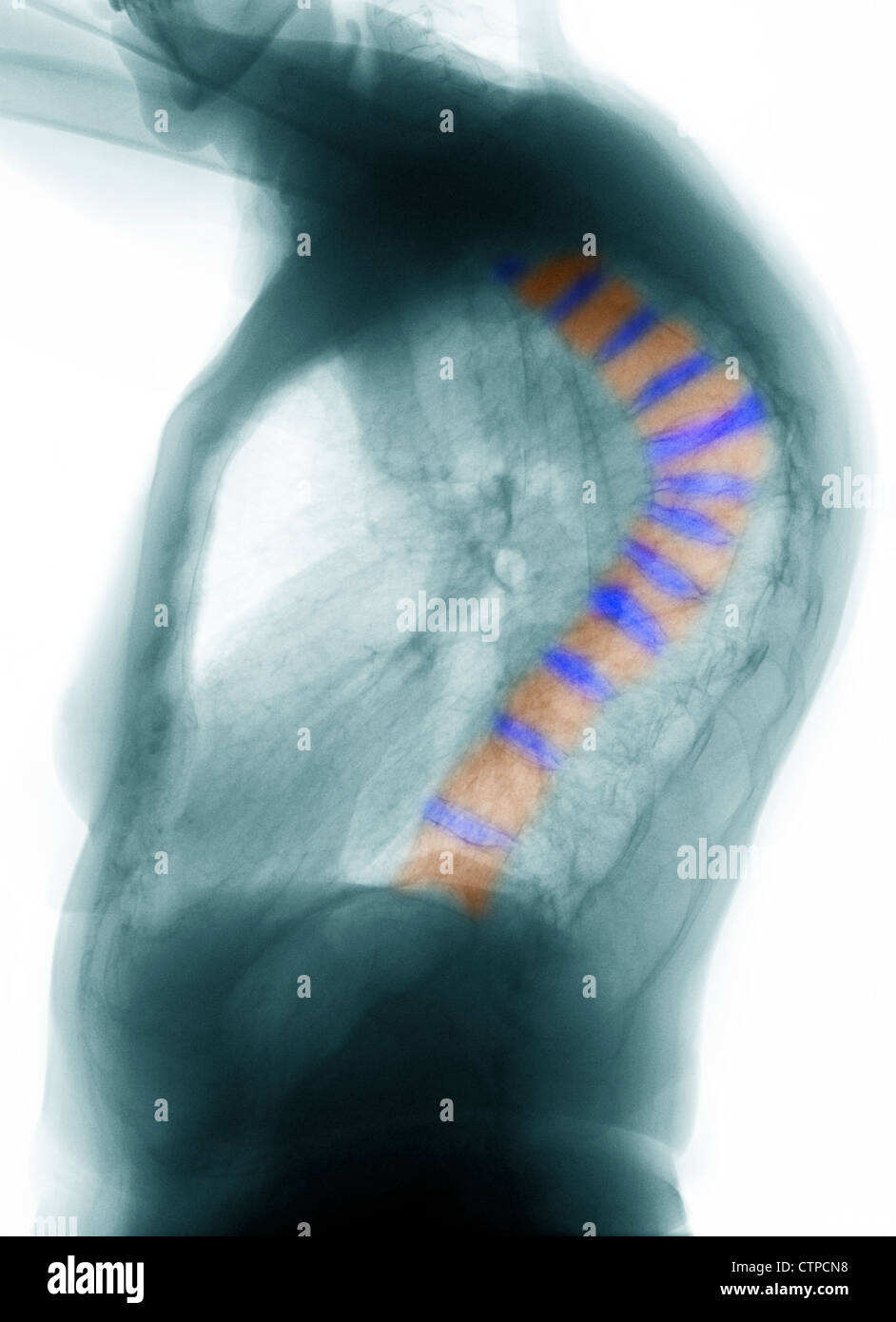 CT scan of the thoracic spine of a  69 year old woman with severe osteoporosis, and compression fractures of the thoracic spine Stock Photo