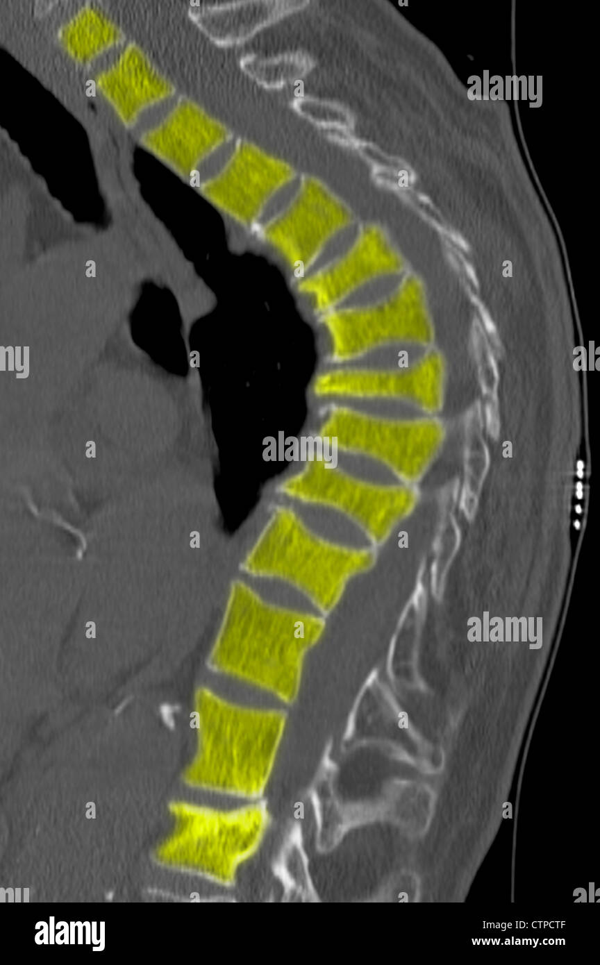 Thoracic spine CT  of a  69 year old woman with osteoporosis. Stock Photo