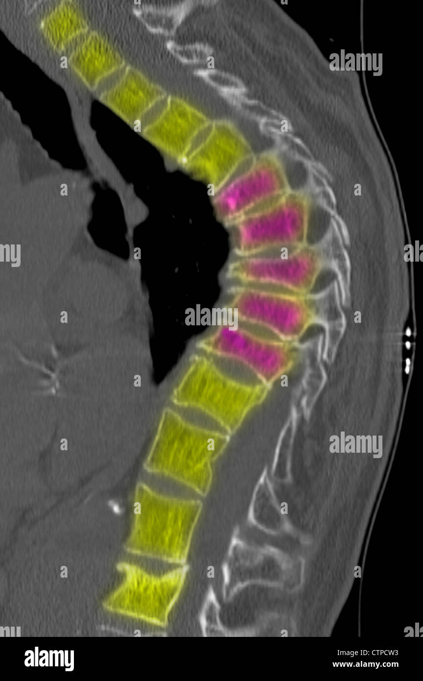 Thoracic spine CT  of a  69 year old woman with osteoporosis. Stock Photo