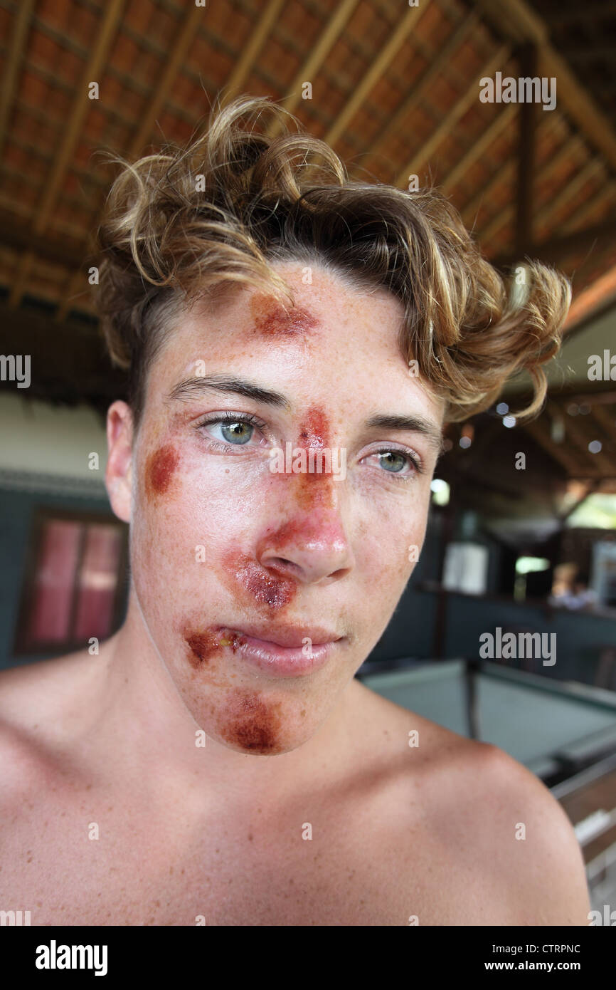 Young Australian surfer with superficial face injuries as a result of hitting the ocean floor while surfing in Sumatra. Stock Photo