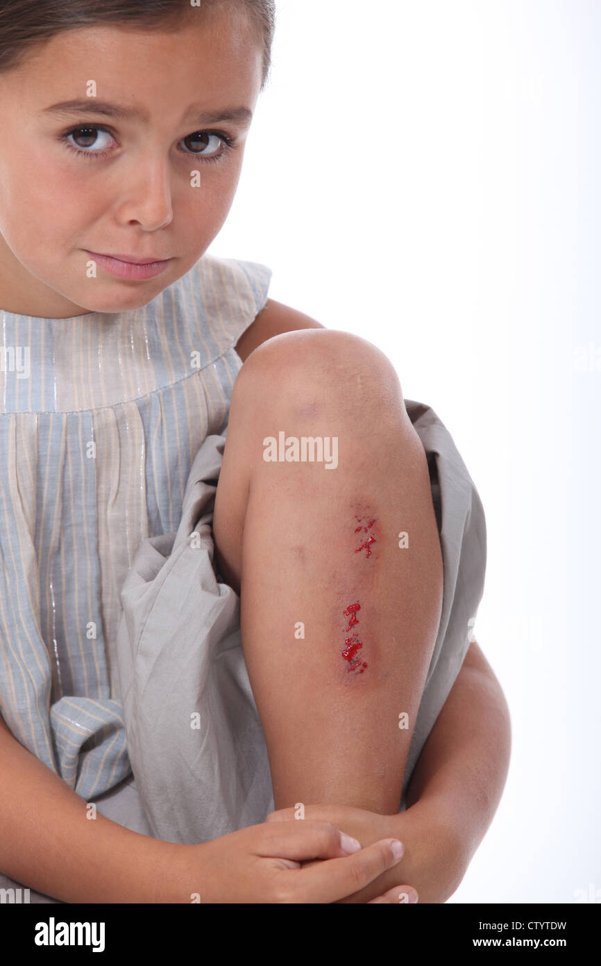 Girl with a grazed leg Stock Photo