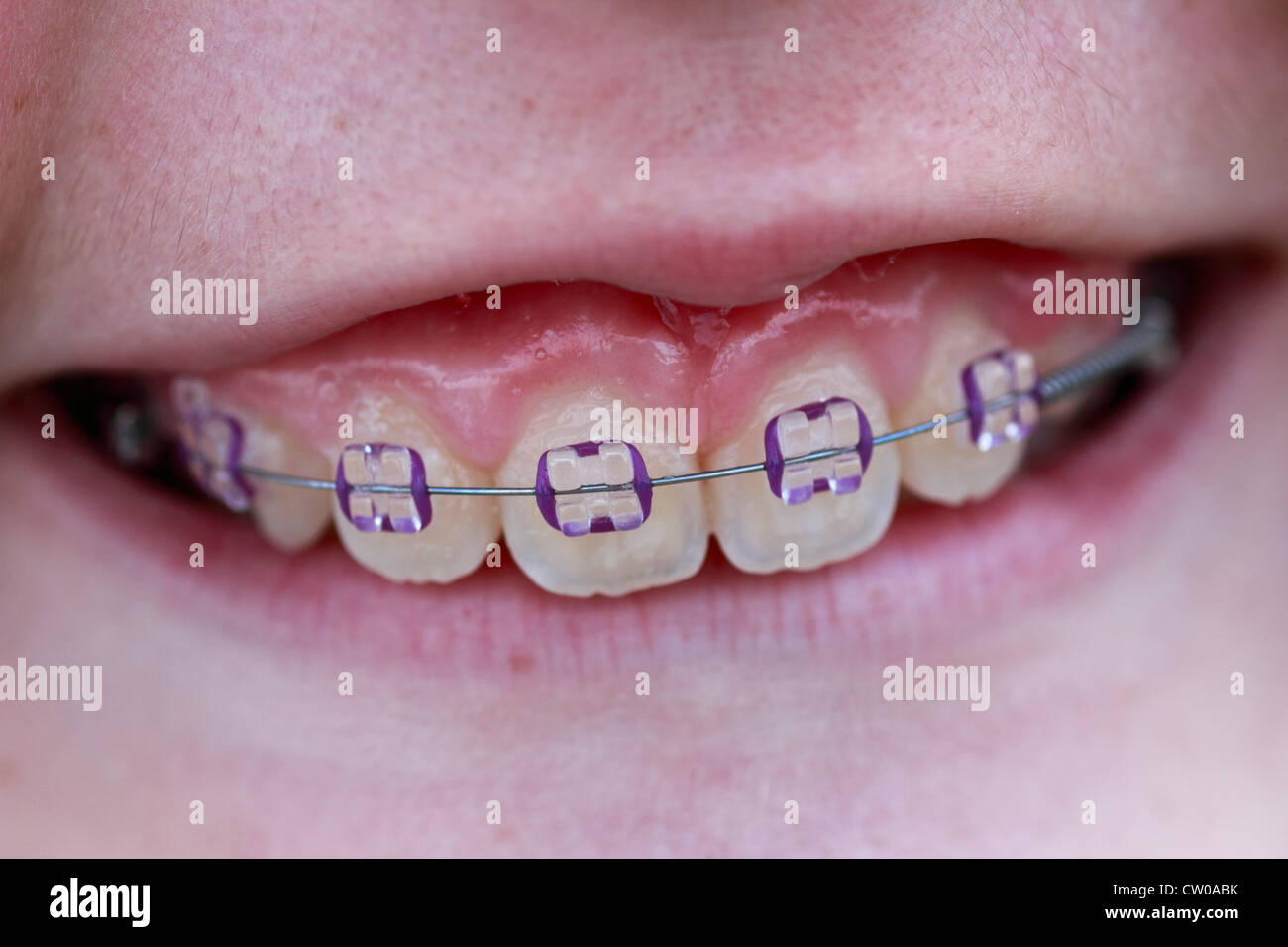 dental braces on an eleven year old girl's teeth Stock Photo Alamy