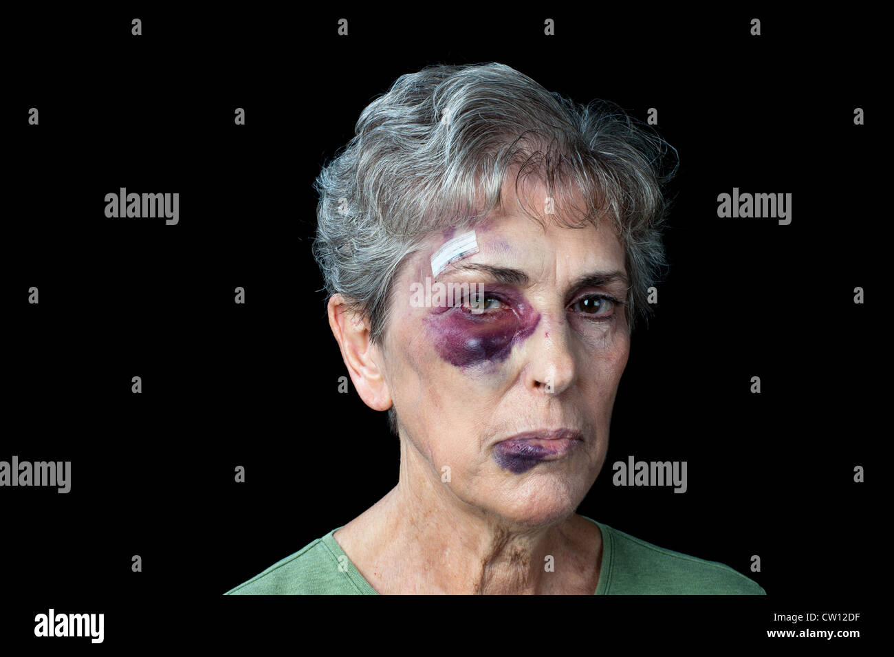 An elderly grandmother badly beaten with stitches, a black eye and a fat lip. Stock Photo