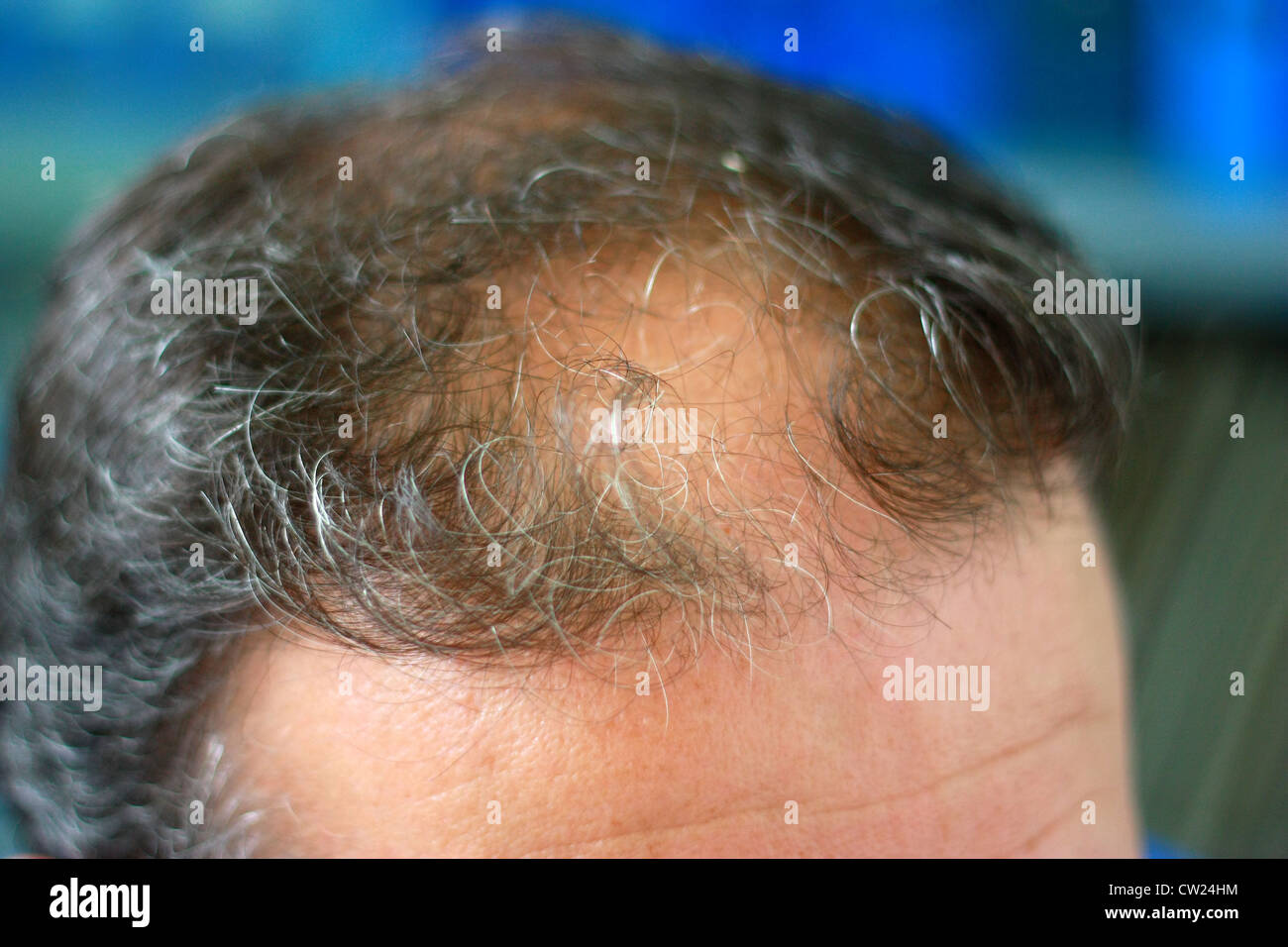 Male head with hair loss symptoms front side Stock Photo - Alamy