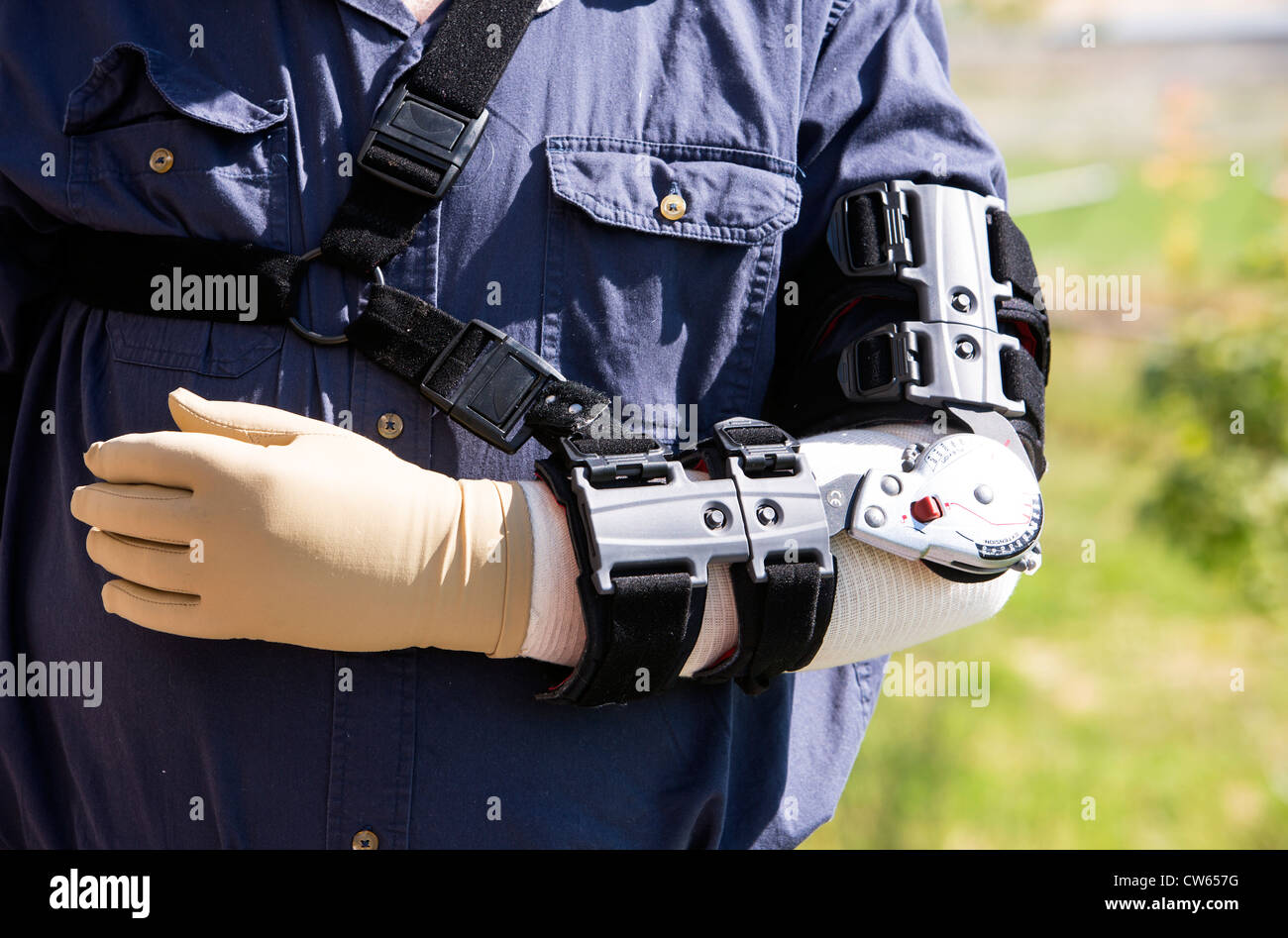 Close up photo showing man with prosthetic device, splint on his arm to