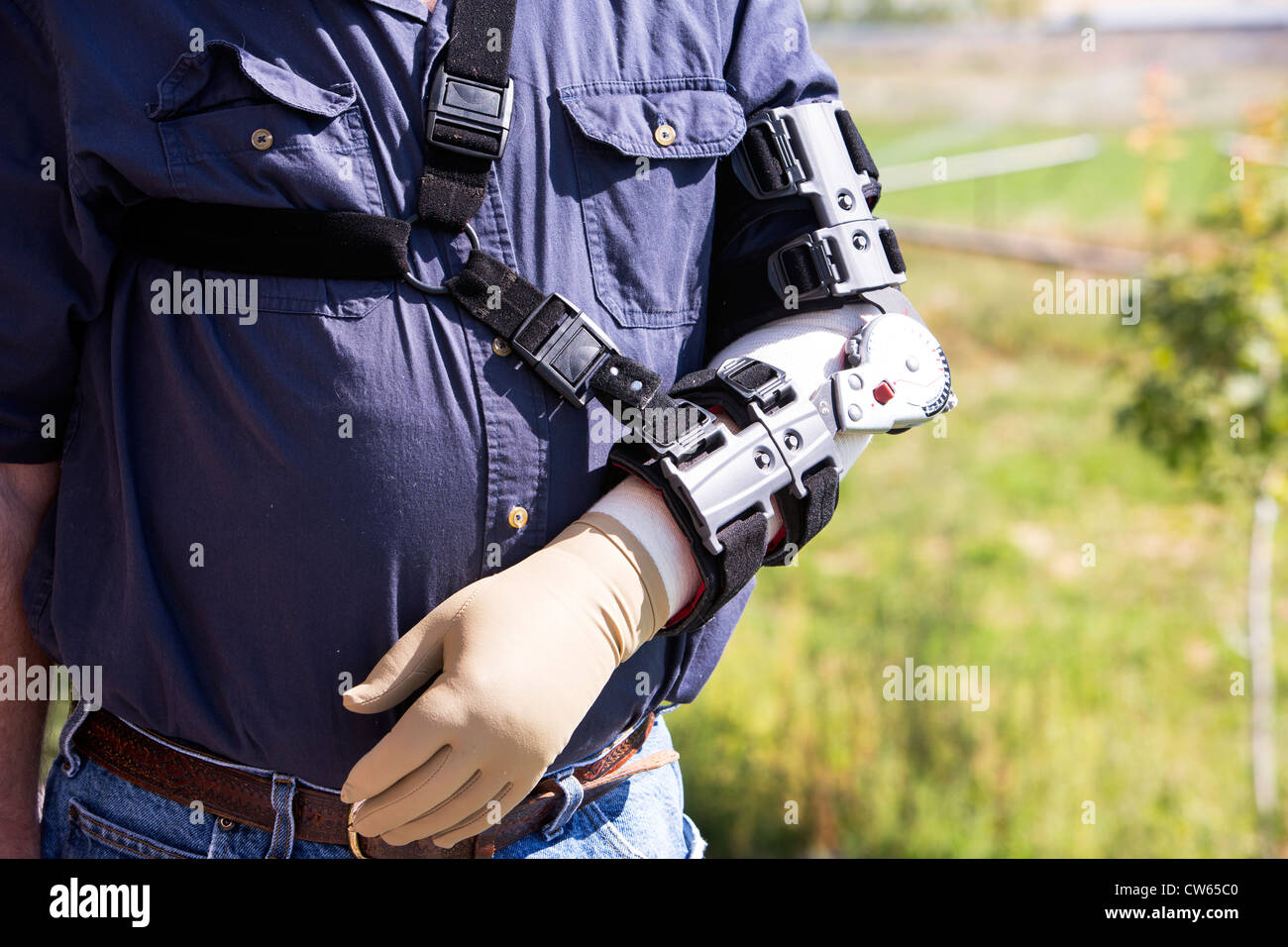 Close up photo showing man with prosthetic device, splint on his arm to