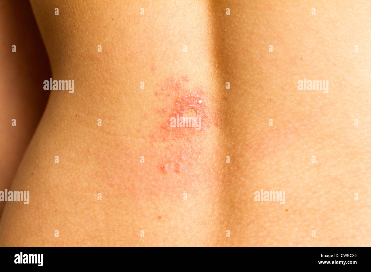 Wound after the removal of a mole. Allergy formed around the wound caused by a band-aid Stock Photo