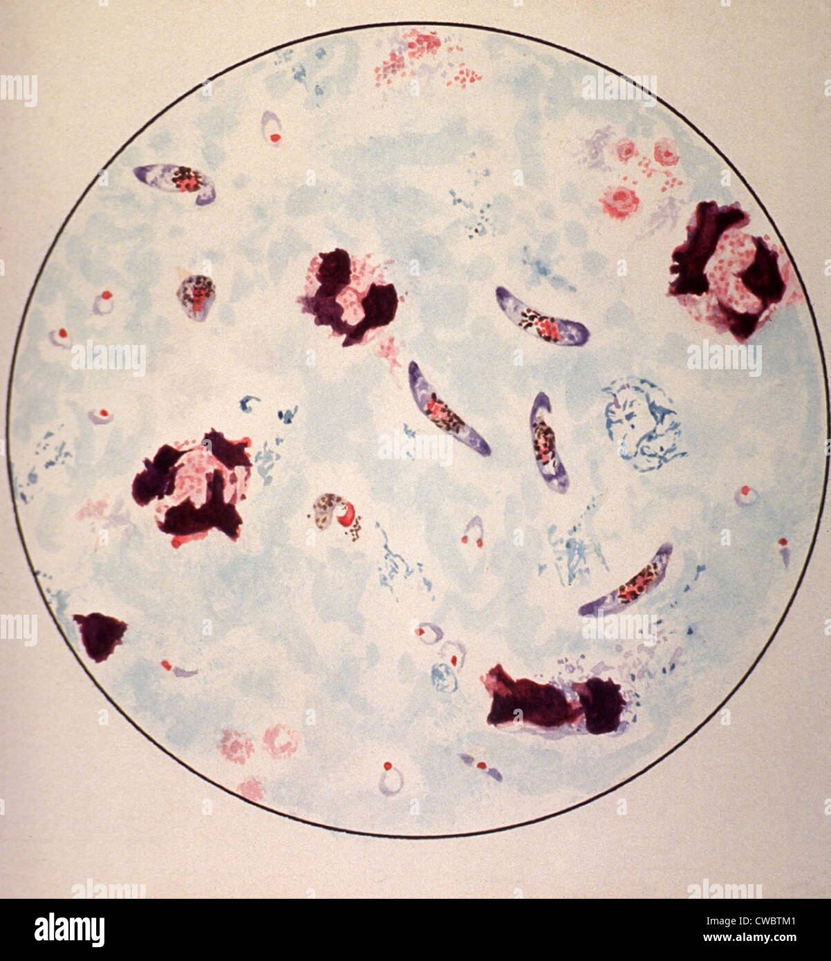 Malaria Diagnosis High Resolution Stock Photography And Images Alamy