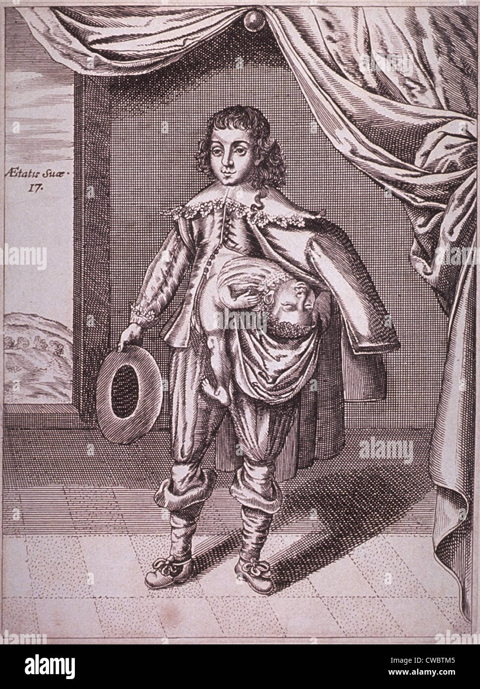 Boy with a deformity caused by a partial conjoined twin growing from his side. 1686 engraving. Stock Photo