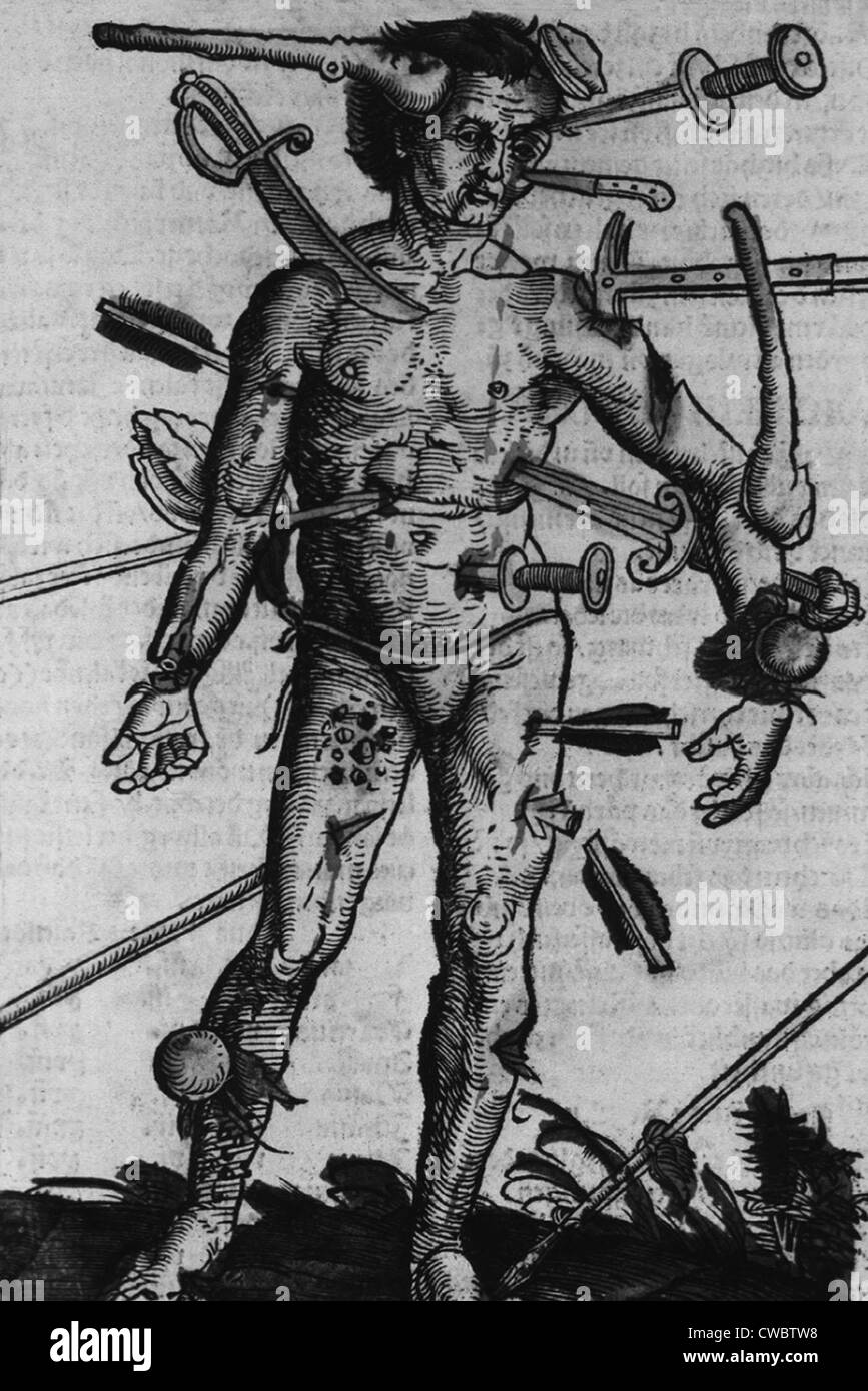 WOUND MAN. A man with wounds from many different kinds of weapons from a field manual for military surgeons. Woodcut by Hans Stock Photo