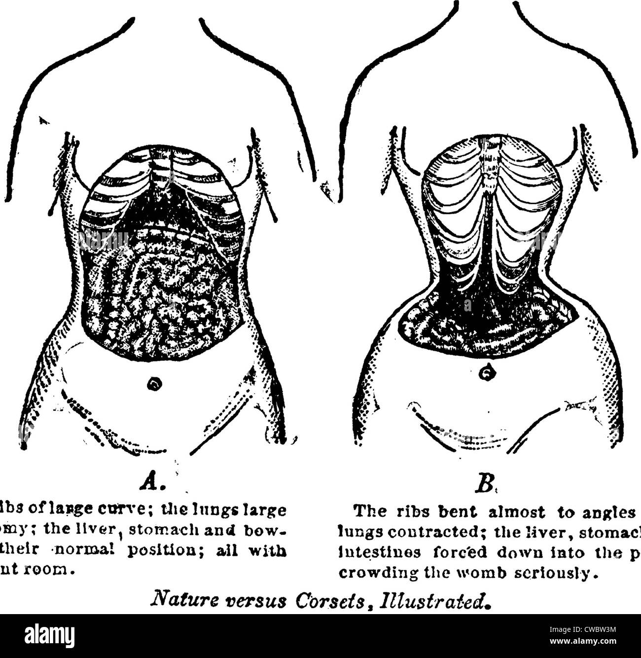 Nature Versus Corsets.' At left is the natural arrangement of a woman's  internal anatomy, contrasted with the corset's effects Stock Photo - Alamy