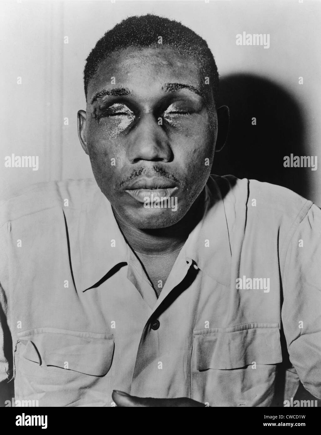 African American man with eyes swollen shut from beating. Ca. 1945-50, Stock Photo