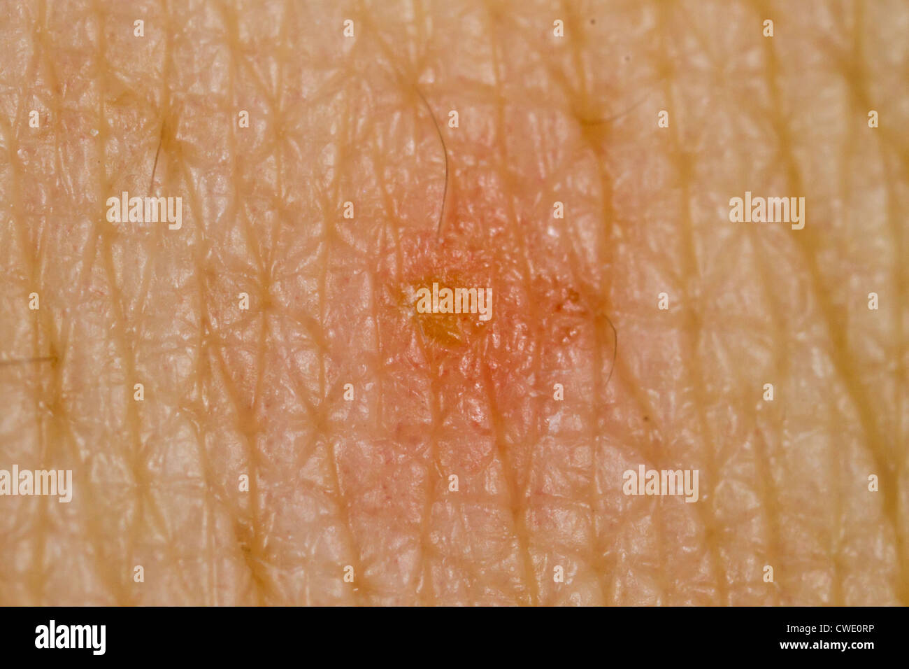 Scabies infected skin, close-up. Stock Photo