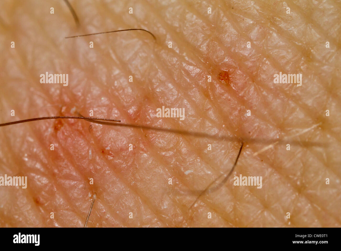 Scabies infected skin, close-up. Stock Photo