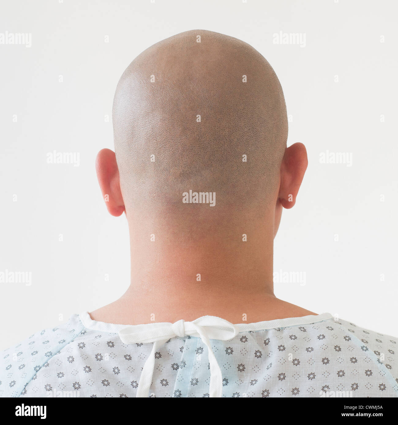 Back view of patient with shaved head Stock Photo