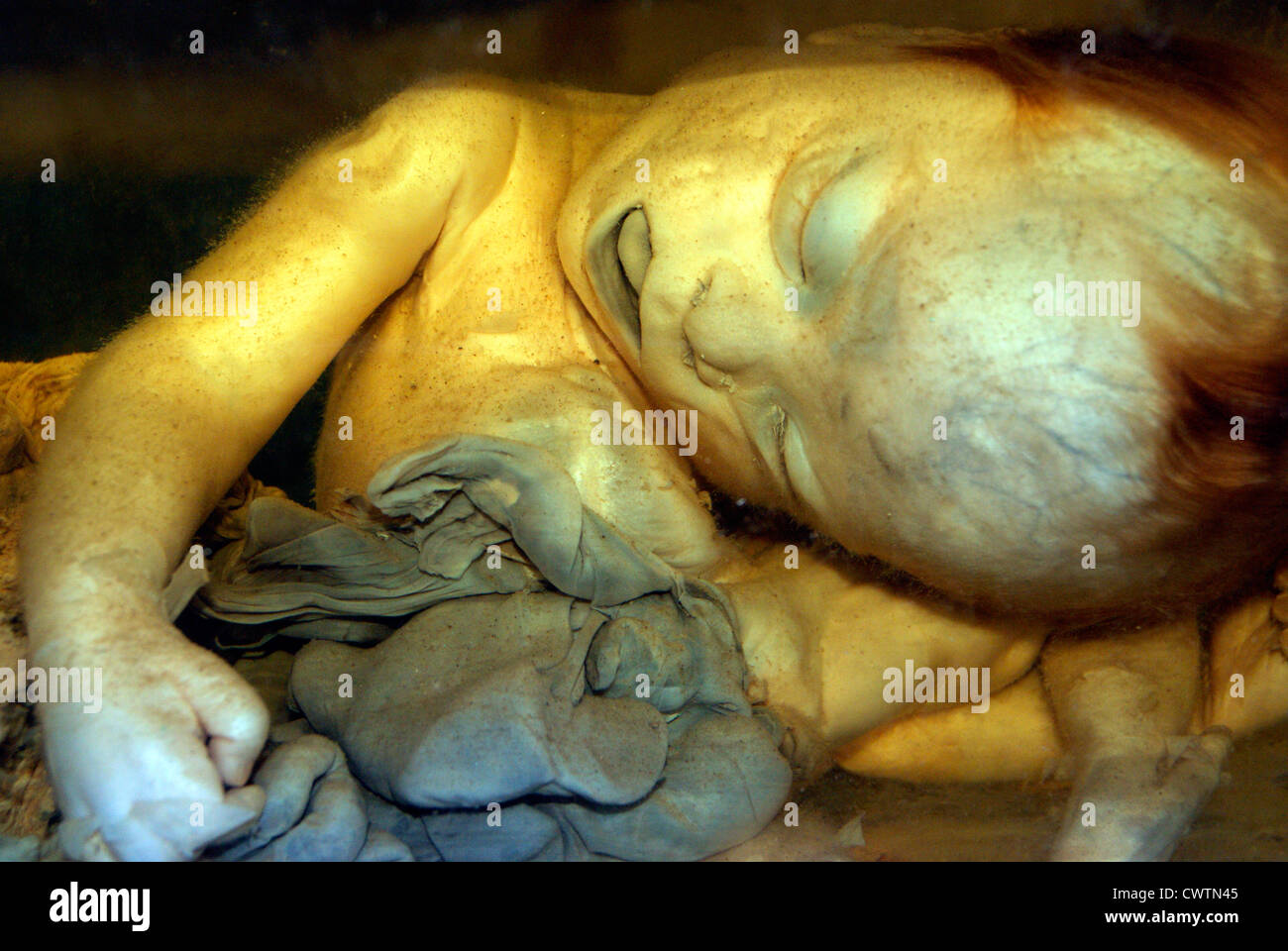 Human Fetus ( Foetus ) in Exomphalos condition preserved in formalin Jar at Medical college hospital India ( original specimen ) Stock Photo