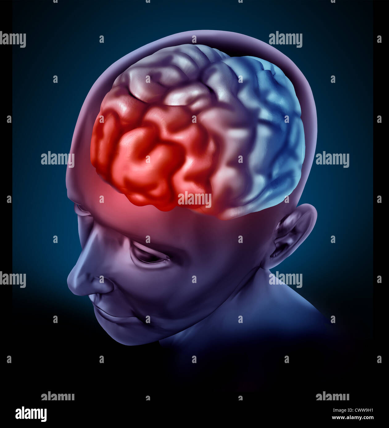 Migrain headache pain represented by a human brain with a ...