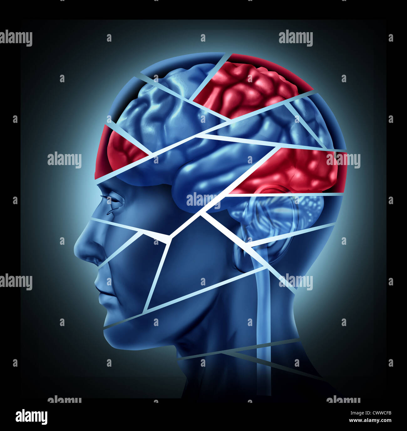 Traumatic brain injury in human brain hi-res stock photography and