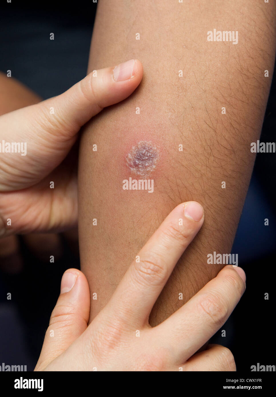 Tuberculosis positive test hires stock photography and images Alamy Tuberculosis positive test hires stock photography and images Alamy