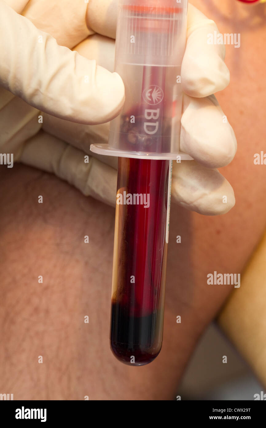 Blood test for TB Stock Photo