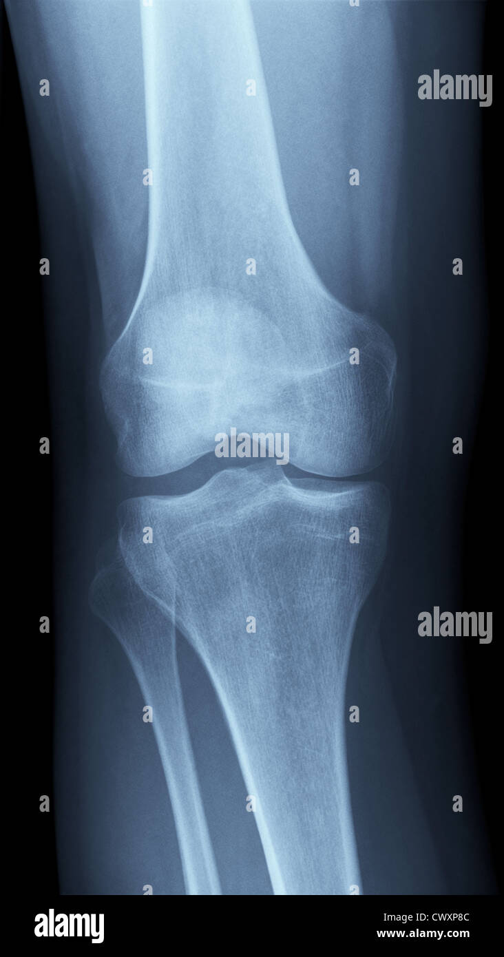 Detailed Xray of a healthy human right knee. Image created using