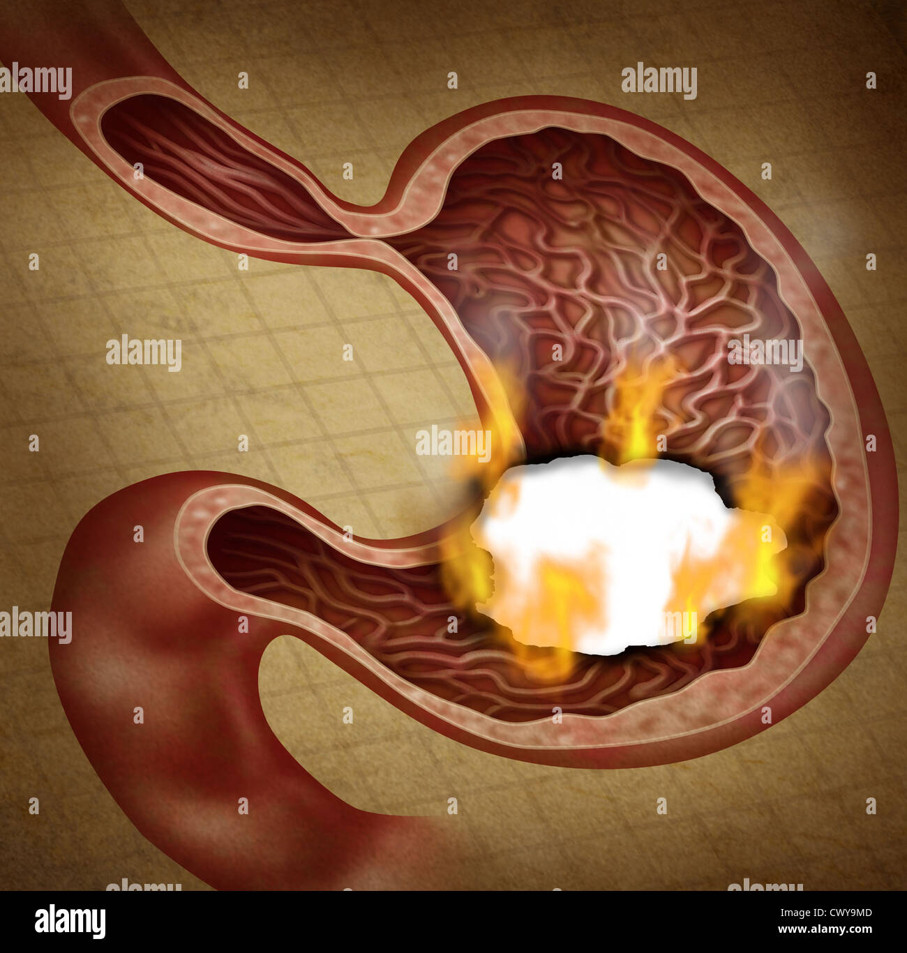 Stomach ulcer and burning indigestion pain in the digestive system with a medical illustration of the human digestion organ with a hole in the document that has a burn with flames as a health care symbol on a grunge texture. Stock Photo