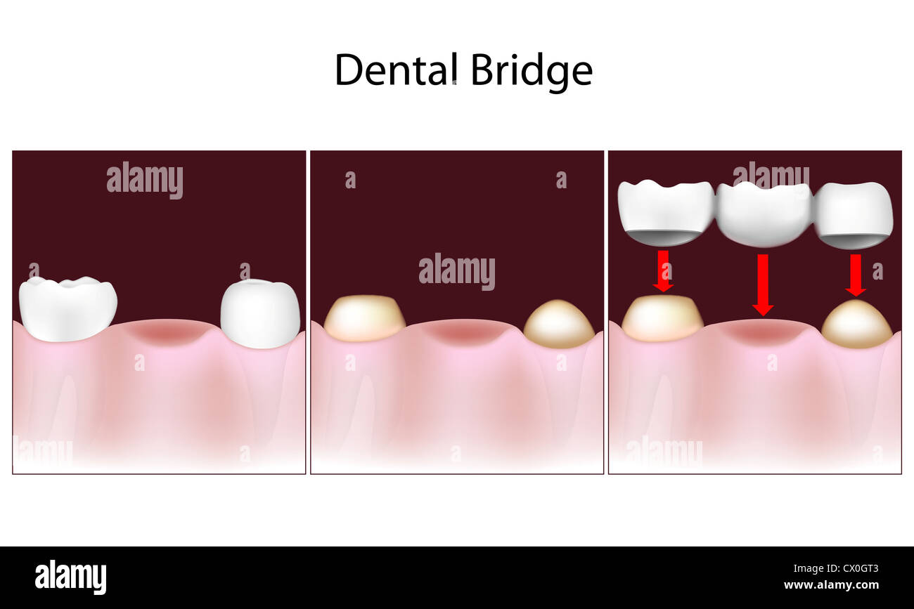 Dental bridge procedure Stock Photo Alamy
