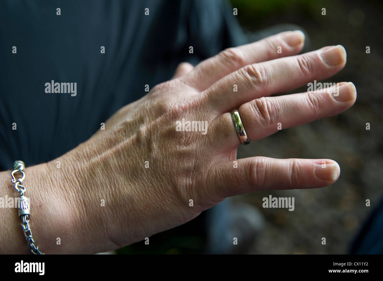 Swollen hand after a hard days walking. Stock Photo