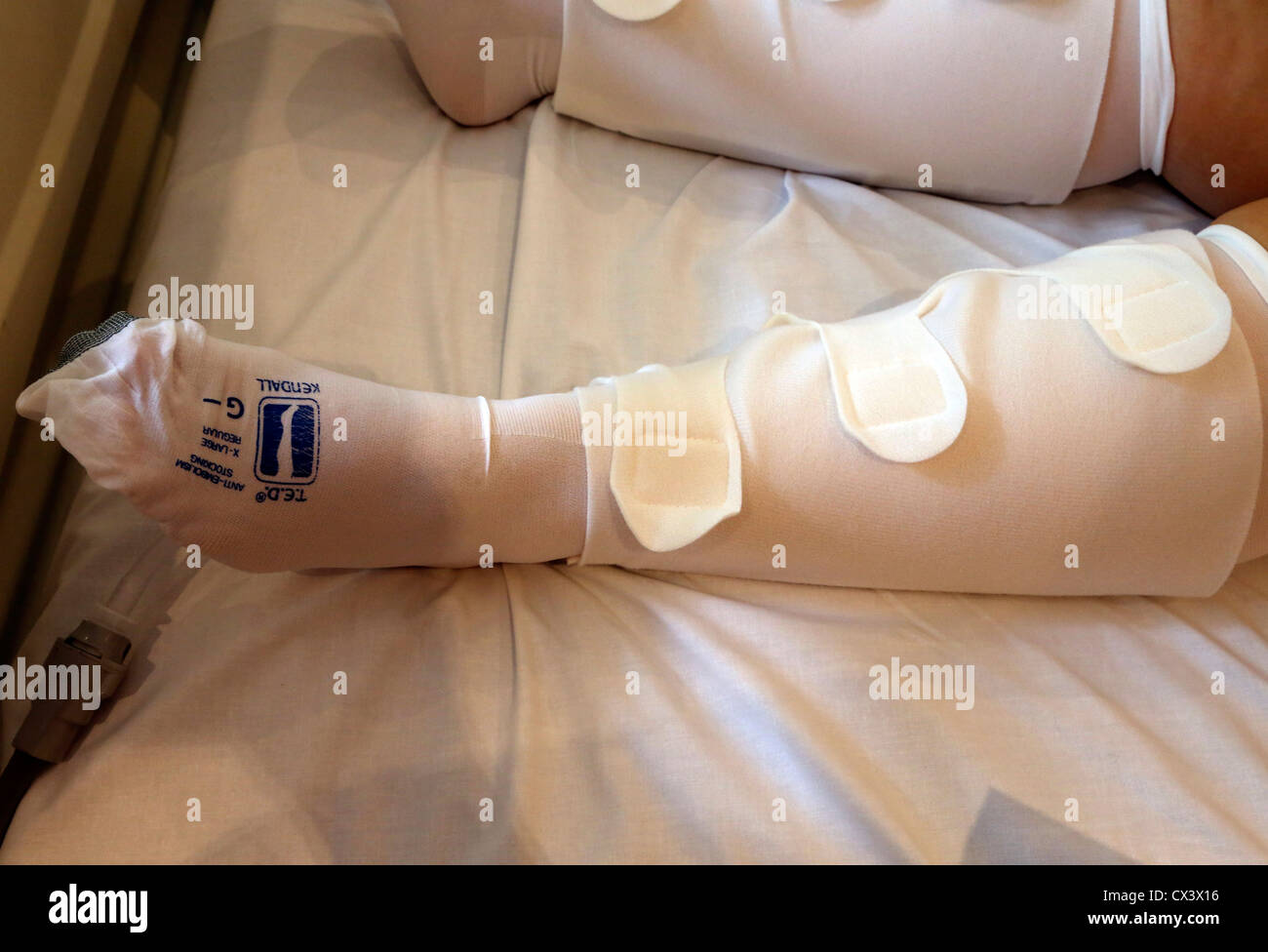 Woman Wearing AntiEmbolism Stockings In Hospital Bed Ashtead Surrey
