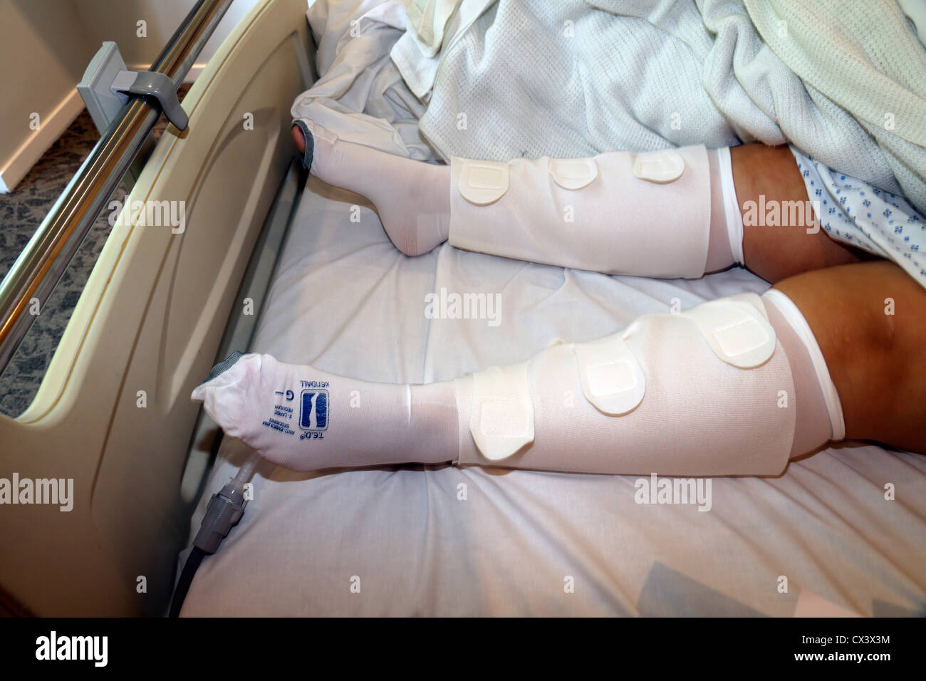 https://c8.alamy.com/comp/CX3X3M/woman-wearing-anti-embolism-stockings-in-hospital-bed-ashtead-surrey-CX3X3M.jpg