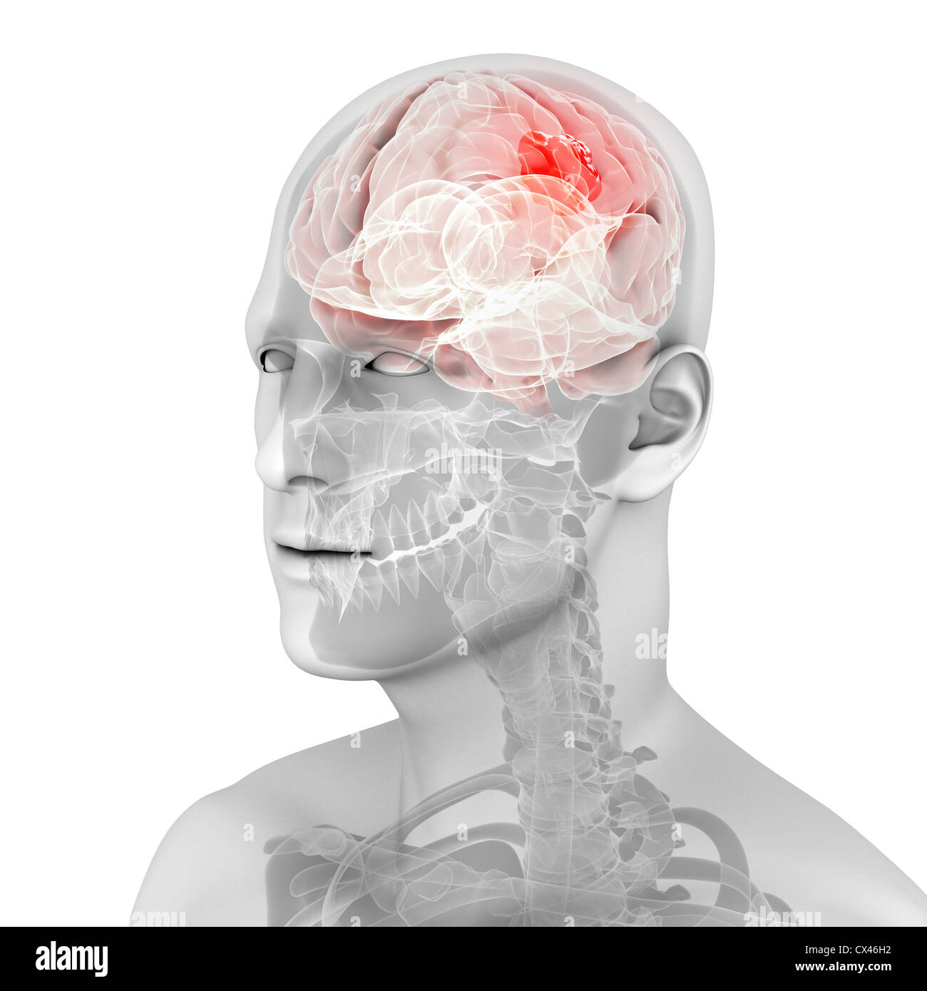 3d rendered medical illustration of a brain tumor Stock Photo