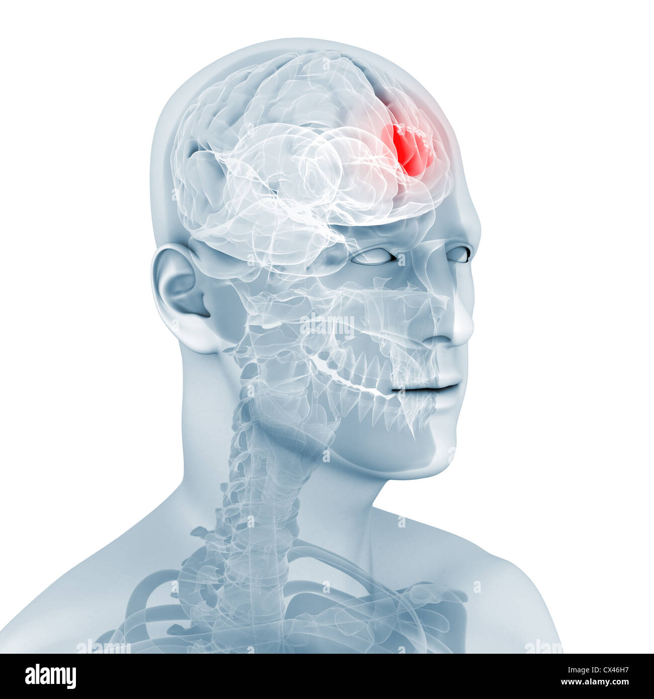 3d rendered medical illustration of a brain tumor Stock Photo