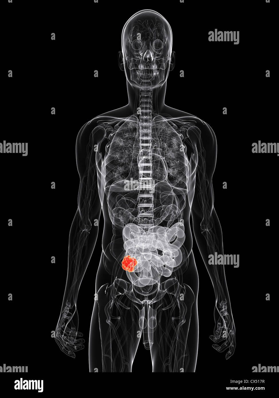 Small intestine cancer Stock Photo - Alamy