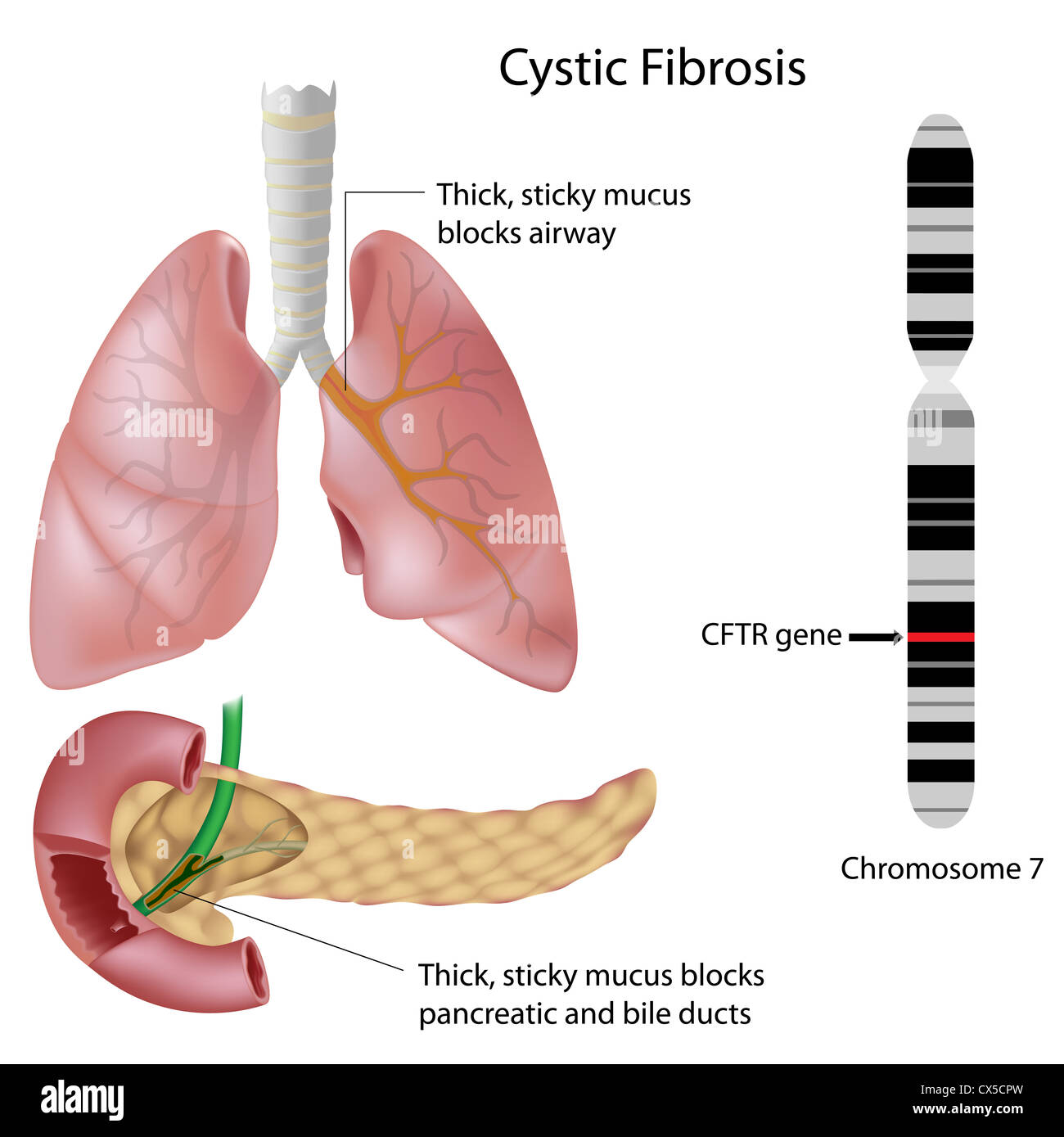 Cystic fibrosis Stock Photo