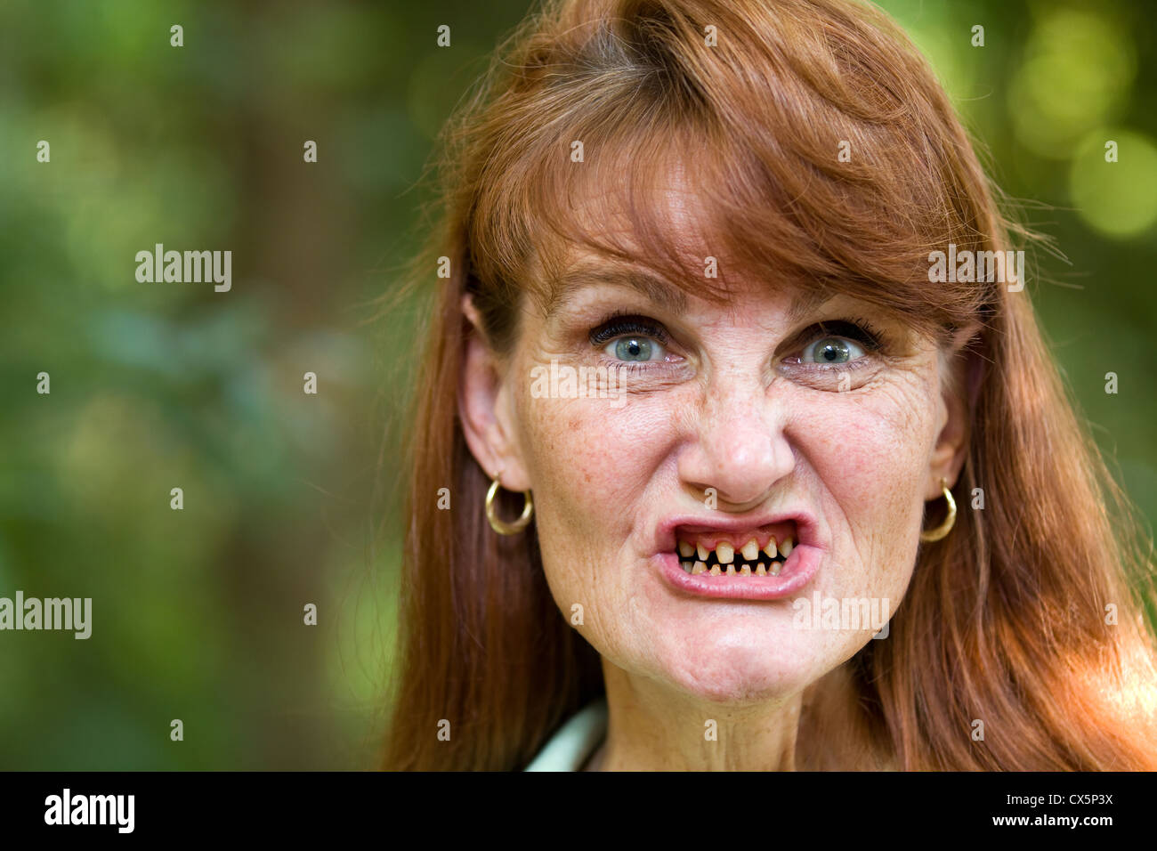 Mature female cancer patient shows her teeth that have been ground down in preparation for a full mouth dental crown. Stock Photo