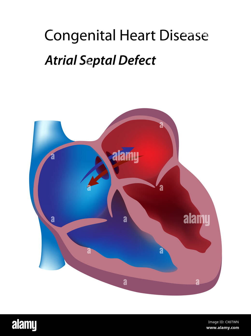 Congenital heart disease: atrial septal defect Stock Photo