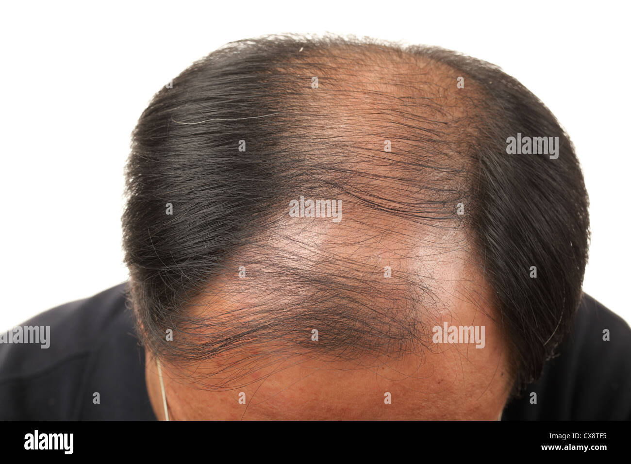 Man with hair loss on white background Stock Photo