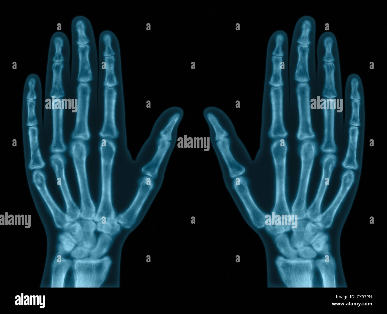 X-ray of both hands. Concept of exam. Stock Photo