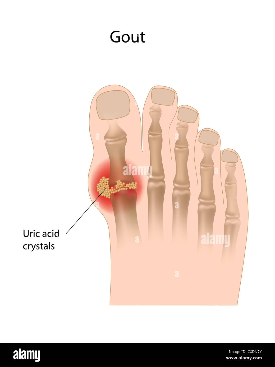 Gout of the big toe Stock Photo