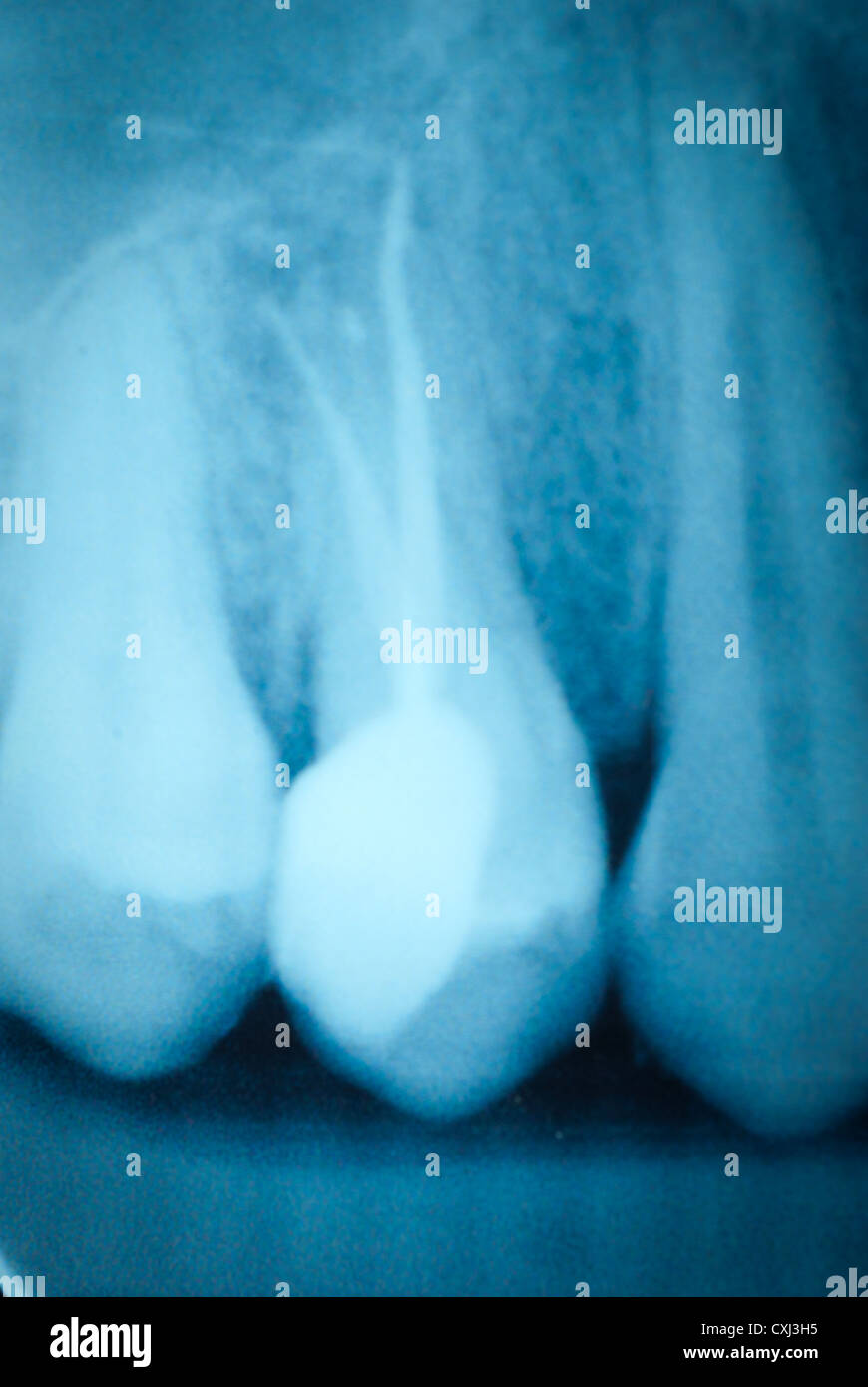 Tooth Microfracture Tooth fracture hi-res stock photography and images - Alamy