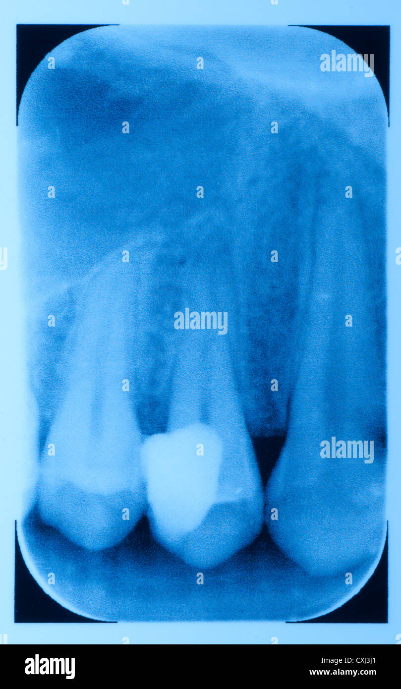 Tooth fracture hires stock photography and images Alamy