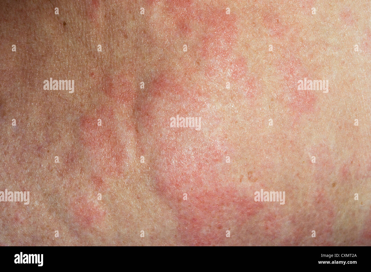 urticarial rash due to an allergic reaction to antibiotics Stock Photo ...
