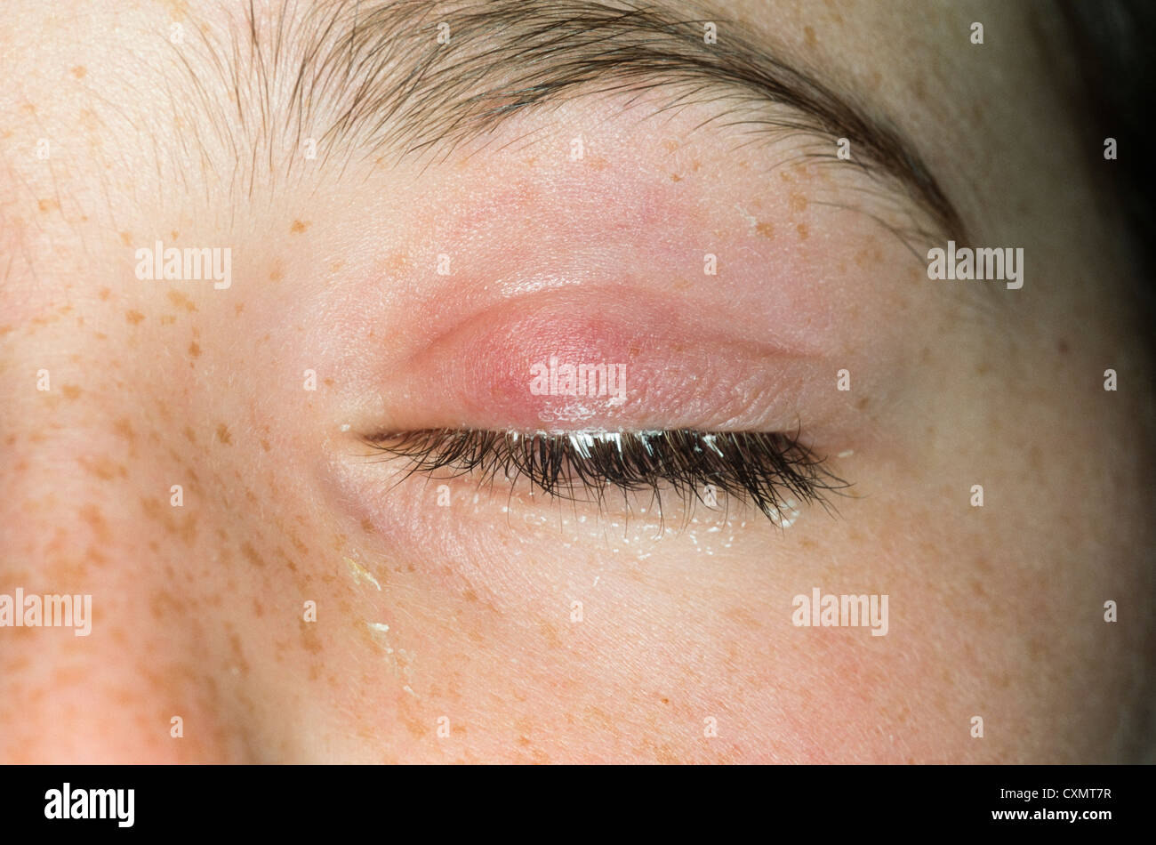 Swelling of the eyelid hires stock photography and images Alamy