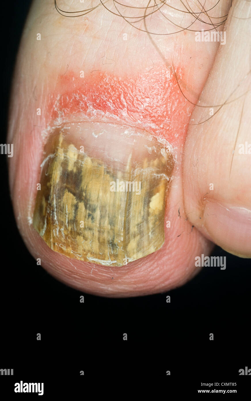 Fungal nail infection of hallux with discolouration, thickening & some distortion -MODEL RELEASED Stock Photo