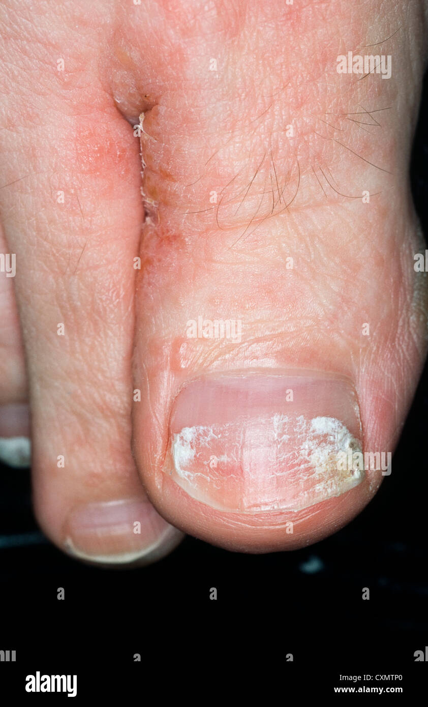 tinea pedis- fungal infection of feet with scaling &  erythema in inter-digital space as fungal nail changes of the hallux nail Stock Photo