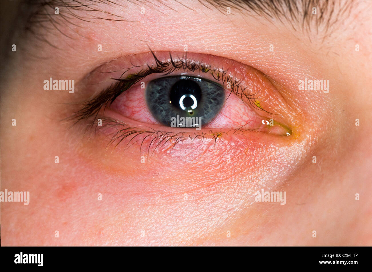 a foreign body on the cornea with inflammation of the sclera after Stock Photo 50860342 Alamy